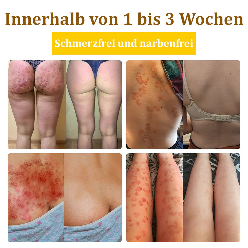 Bostore™ Bienengift-Therapie-Creme, zur Behandlung von Ekzemen, Akne, Altersflecken, Krampfadern, Hautrissen, Pilzinfektionen und Warzen sowie anderen Hautproblemen.🌿