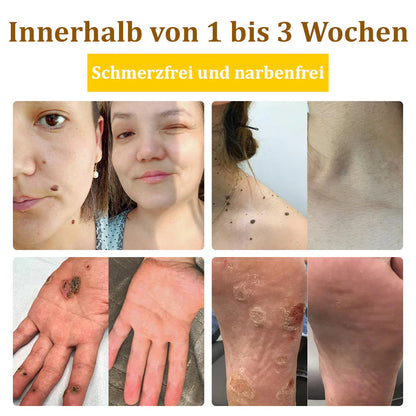 Bostore™ Bienengift-Therapie-Creme, zur Behandlung von Ekzemen, Akne, Altersflecken, Krampfadern, Hautrissen, Pilzinfektionen und Warzen sowie anderen Hautproblemen.🌿