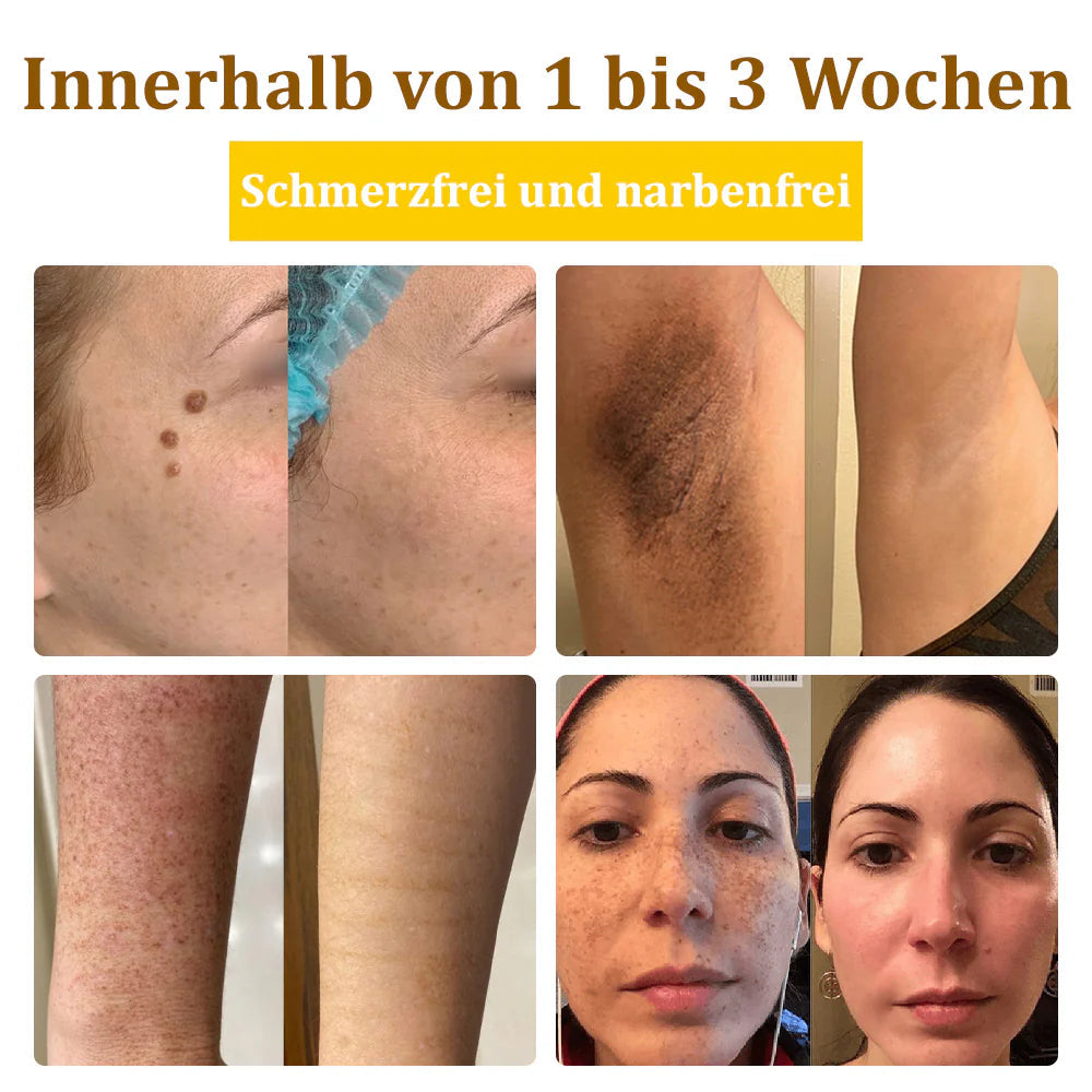 Bostore™ Bienengift-Therapie-Creme, zur Behandlung von Ekzemen, Akne, Altersflecken, Krampfadern, Hautrissen, Pilzinfektionen und Warzen sowie anderen Hautproblemen.🌿